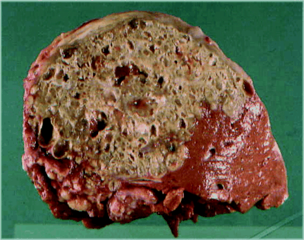 Napadnutá ľudská pečeň. FOTO: Archív D.A.