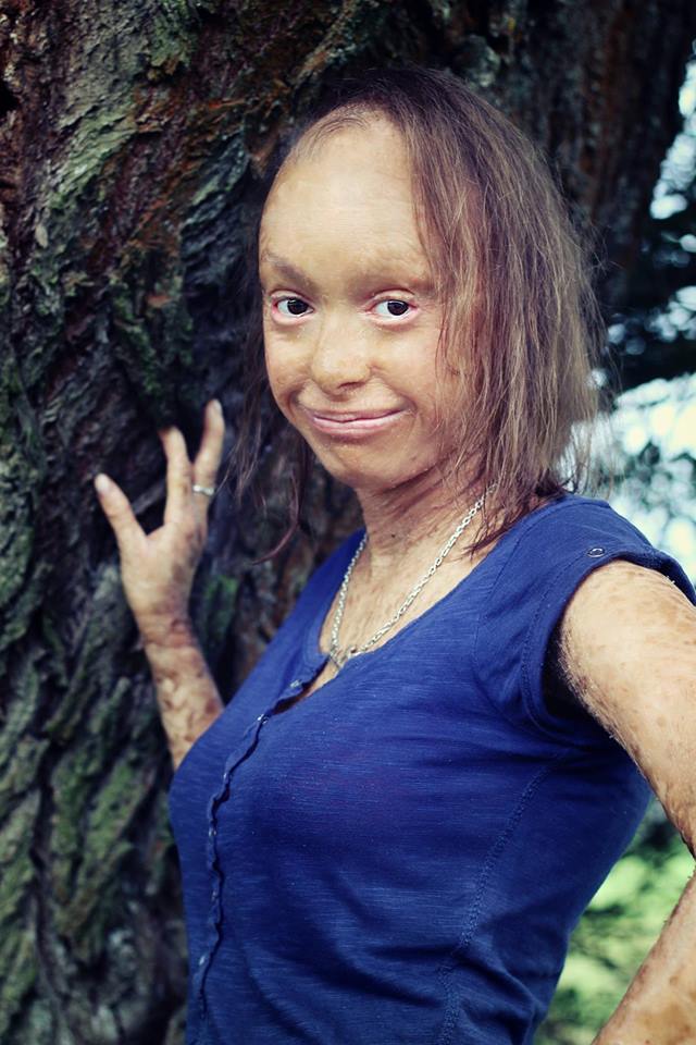 Nikola sa s ichtyózou naučila žiť. Foto: Archív N.K.