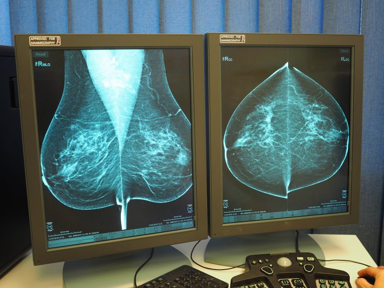 Úspešná liečba rakoviny prsníka závisí od včasnej diagnostiky. FOTO: preventivne.sk