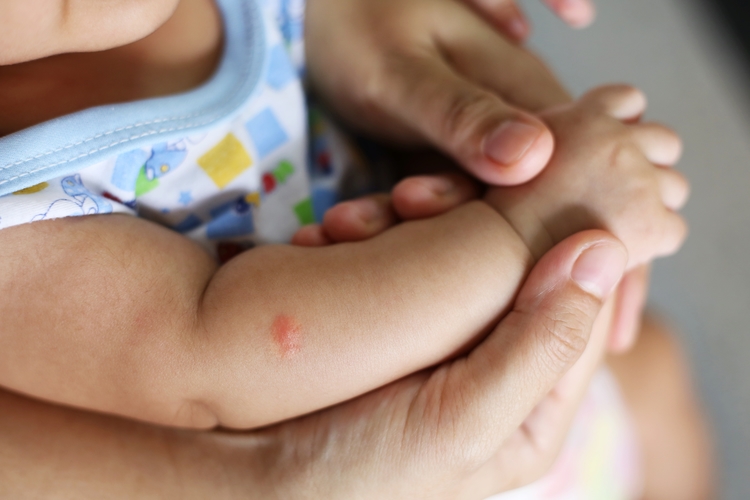Niektorí môžu na poštípanie komárom reagovať aj zvýšenou teplotou. FOTO: Adobe Stock